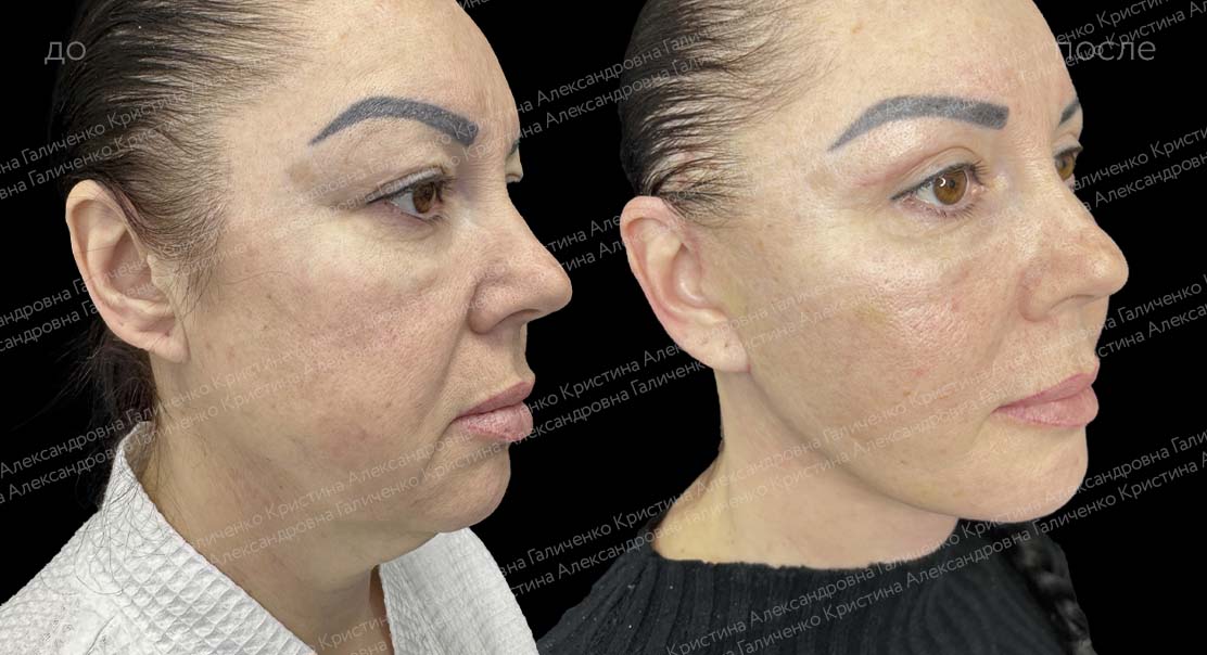 Фейслифтинг + платизмопластика + блефаропластика