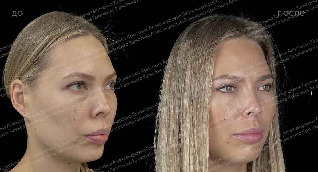 Трансконъюнктивальная нижняя блефаропластика