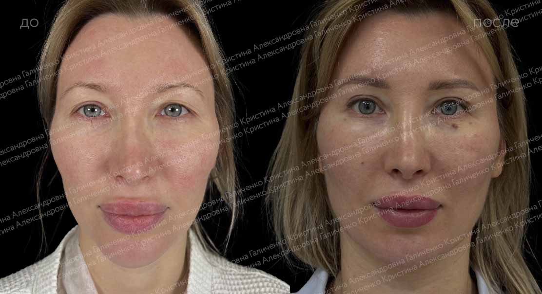Эндоскопический лобно-височный лифтинг + верхняя блефаропластика