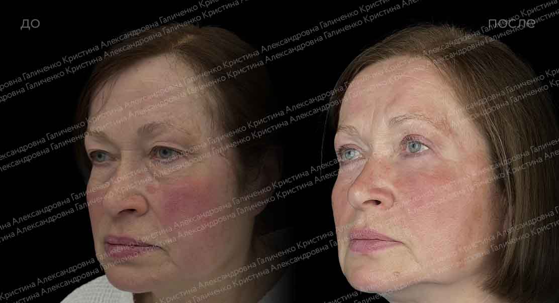 Круговая блефаропластика с миопексией