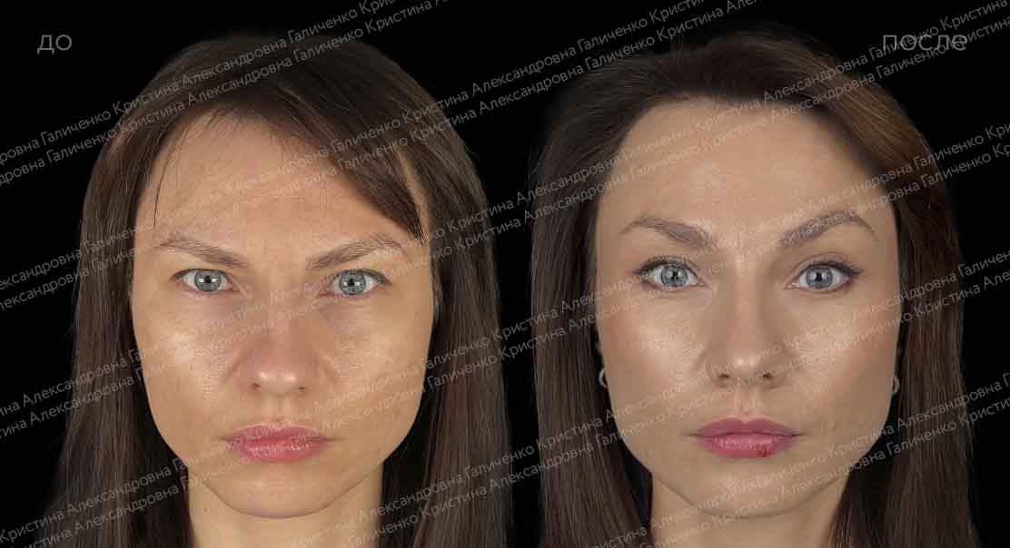 Эндоскопический лобно-височный лифтинг