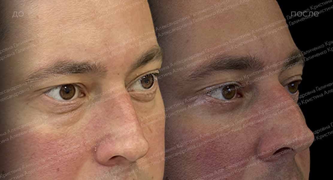Нижняя блефаропластика и пластика нижней трети лица