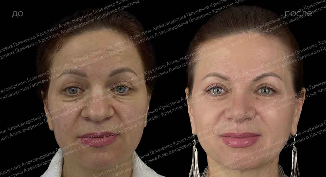 Нижняя блефаропластика и миопексия