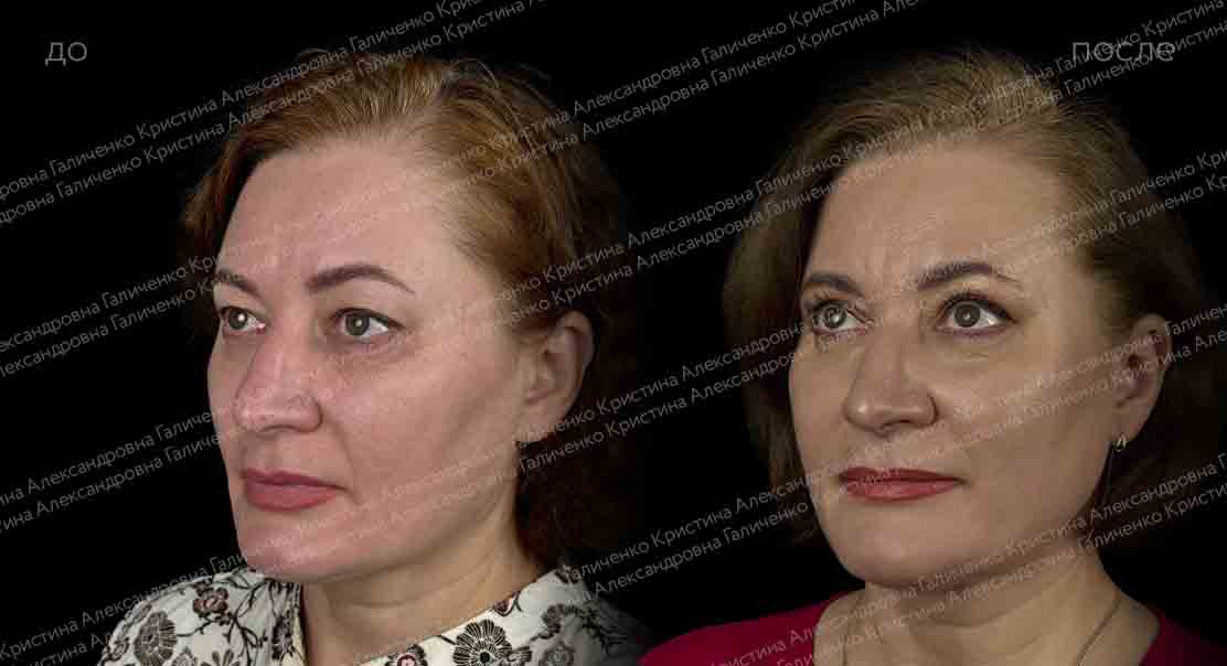 Верхняя блефаропластика