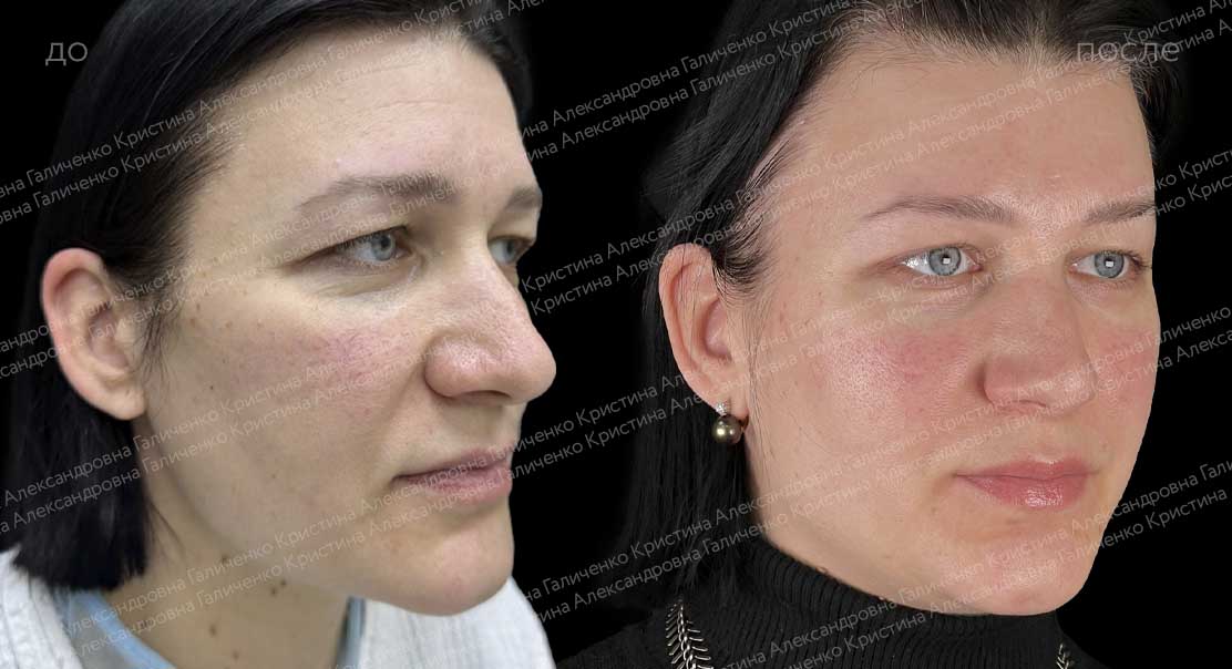 Верхняя блефаропластика + подтяжка лба и висков