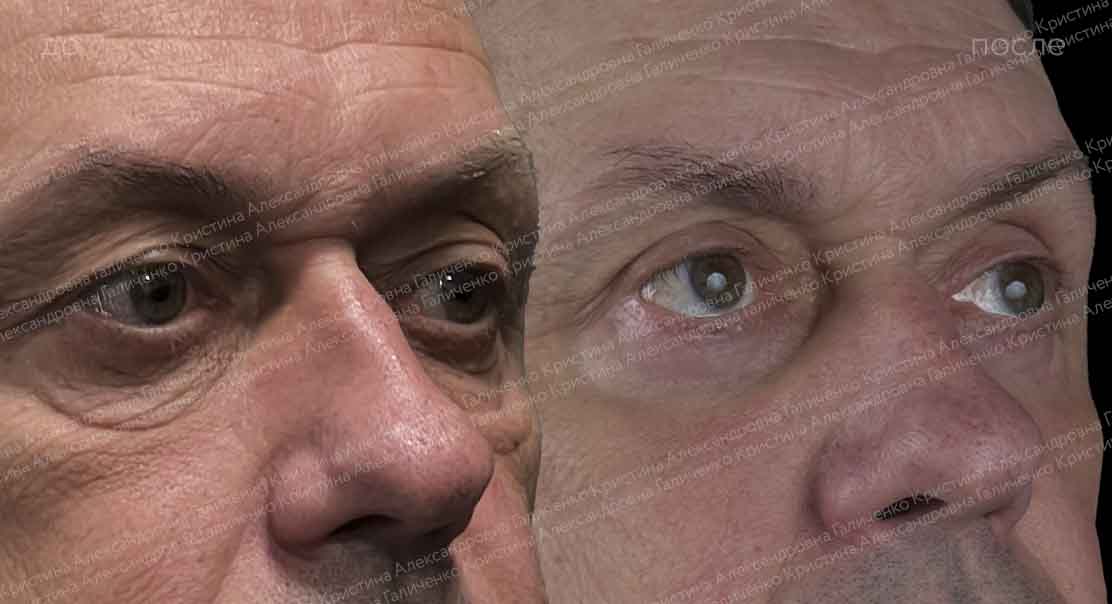 Пластика верхних и нижних век