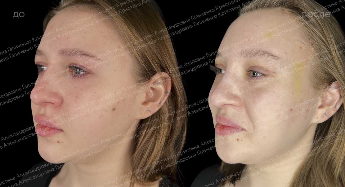 Подтяжка лба и виска + эффект "лисьего взгляда"