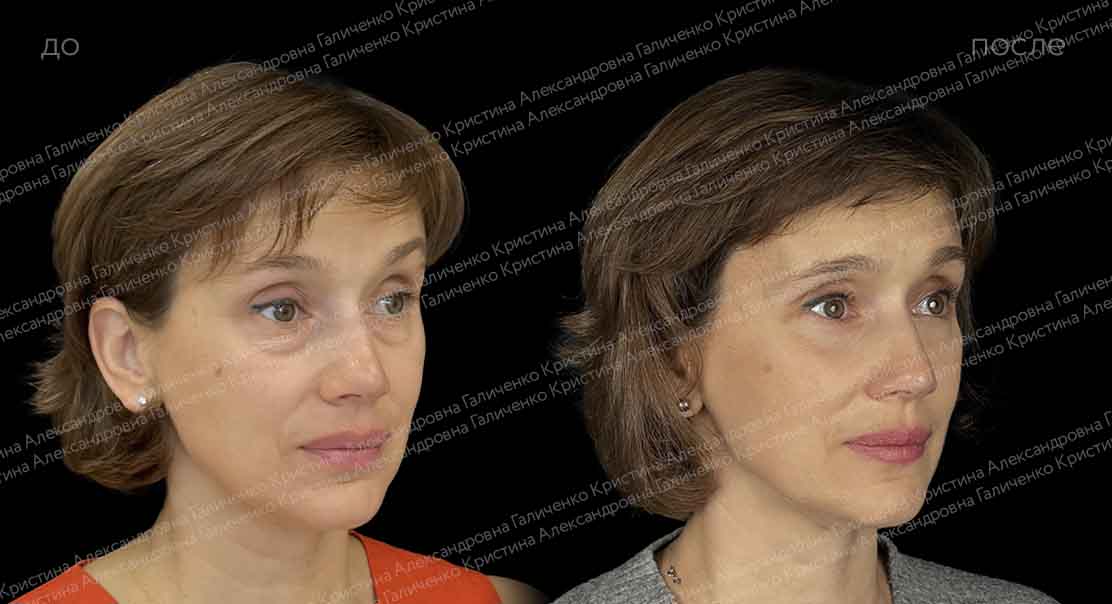 Нижняя блефаропластика и миопексия