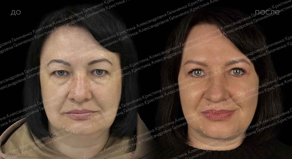 Круговая блефаропластика и миопексия