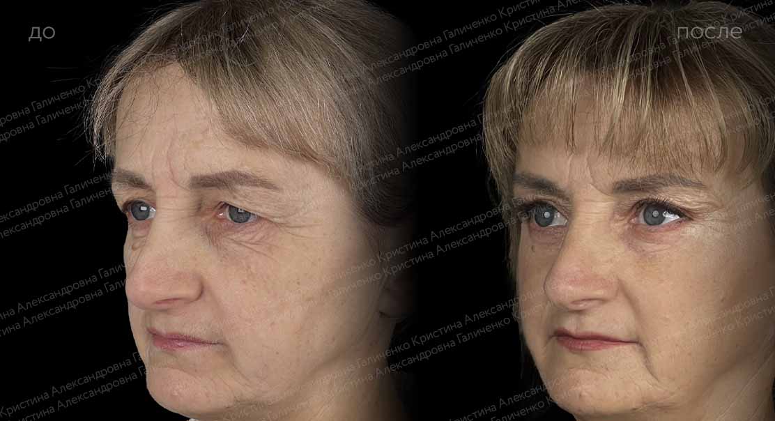 Эндоскопический лобно-височный лифтинг + круговая блефаропластика