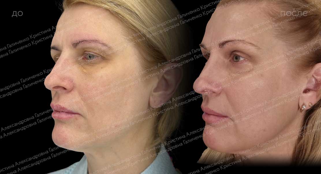 Нижняя блефаропластика + эндоскопический лобно-височный лифтинг