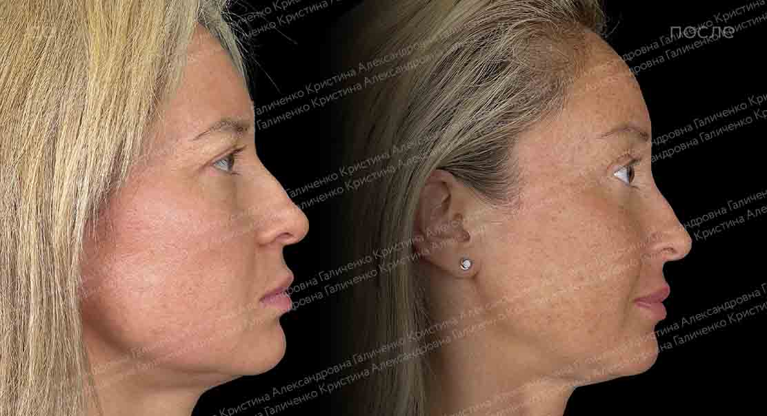 Нижняя трансконъюнктивальная блефаропластика + эндоскопический лобно-височный лифтинг + чик-лифтинг