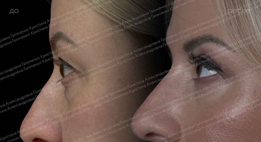 Круговая блефаропластика