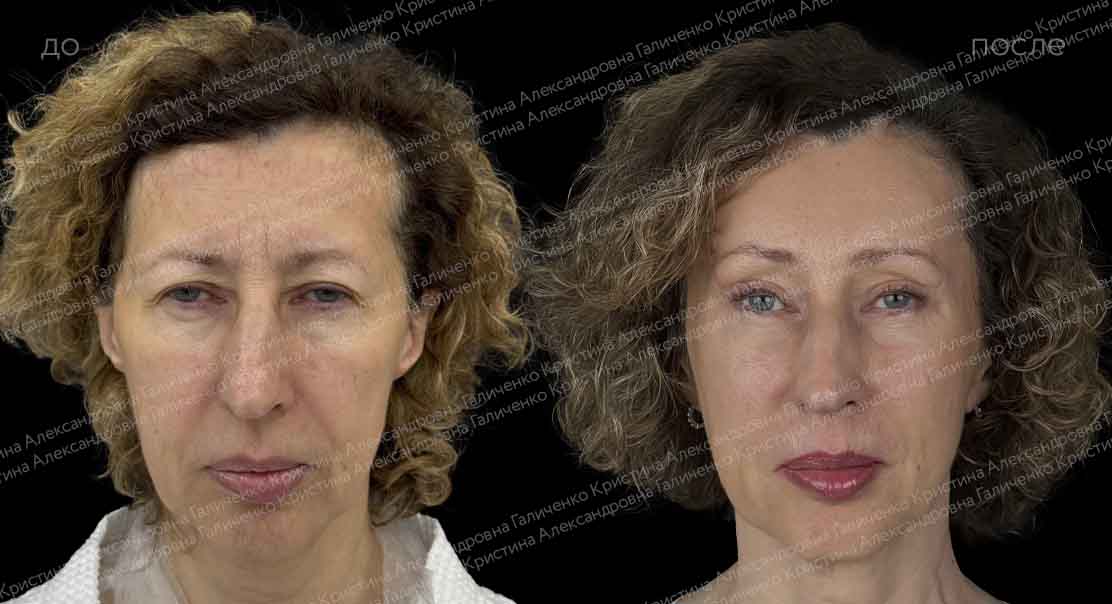 Верхняя блефаропластика + эндоскопический лобно-височный лифтинг