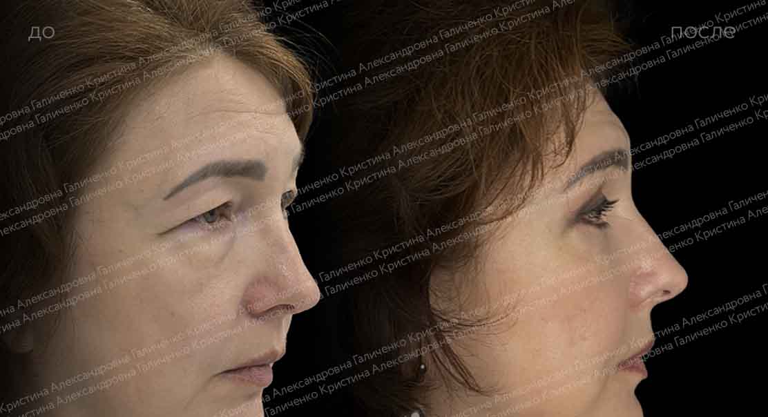 Круговая блефаропластика с миопексией