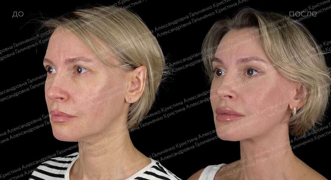 Платизмопластика + эндоскопический лобно-височный лифтинг