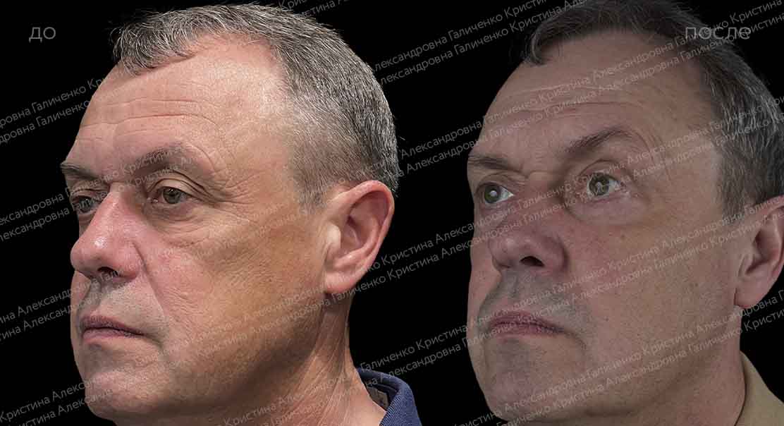 Пластика верхних и нижних век