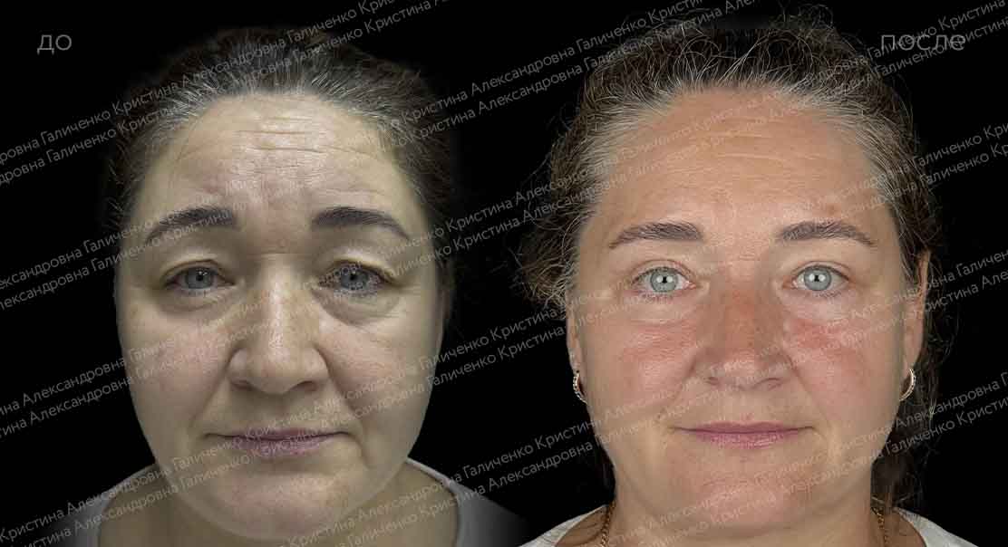 Пластика верхних и нижних век + миопексия
