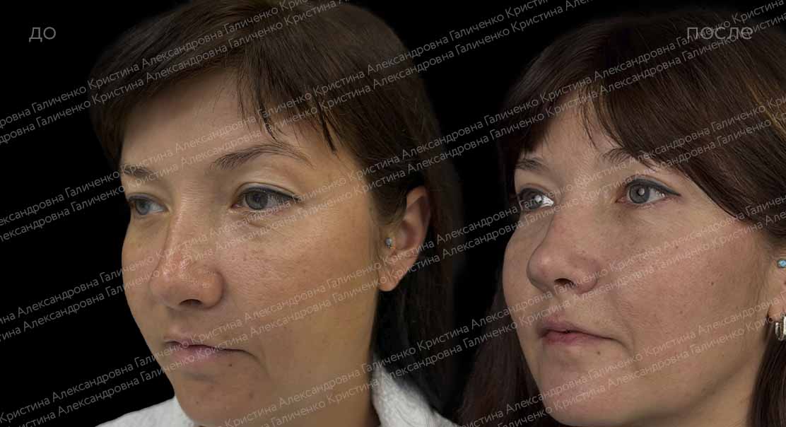 Верхняя блефаропластика