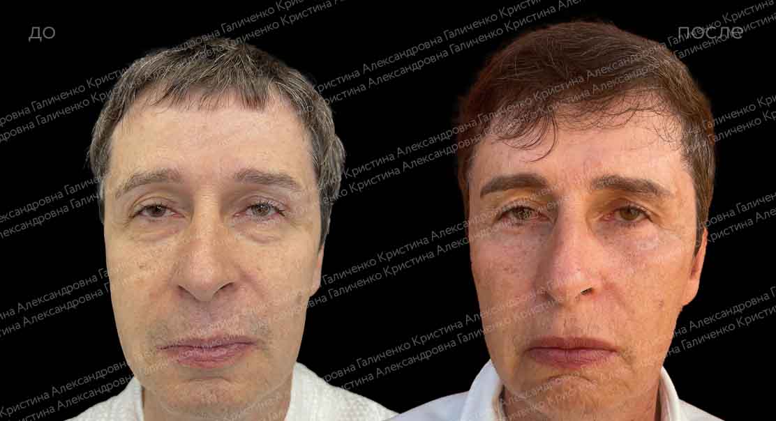 Классическая нижняя блефаропластика