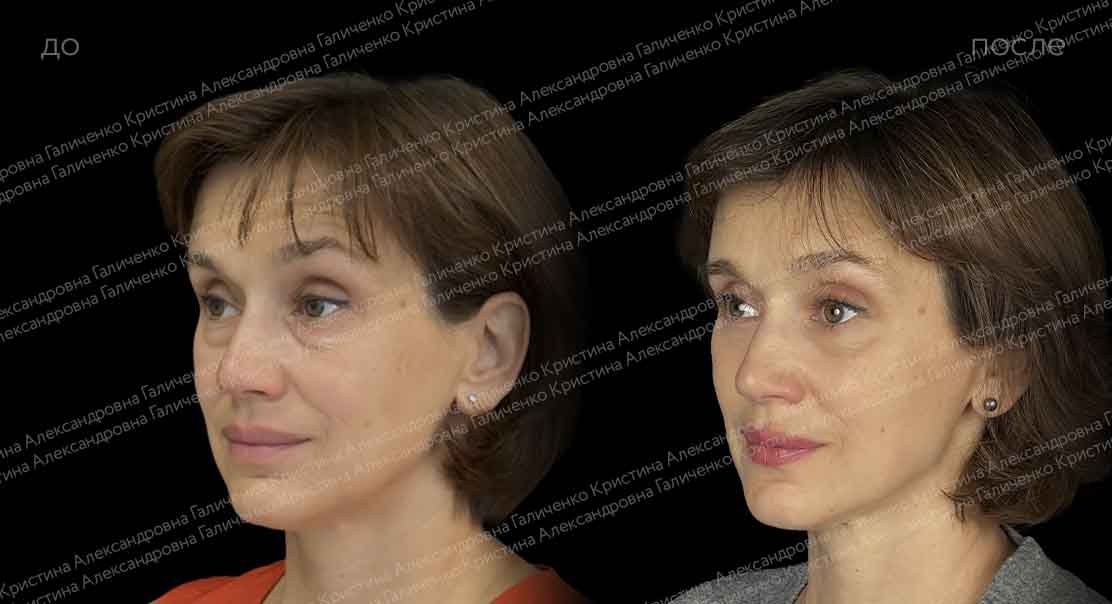 Нижняя блефаропластика и миопексия