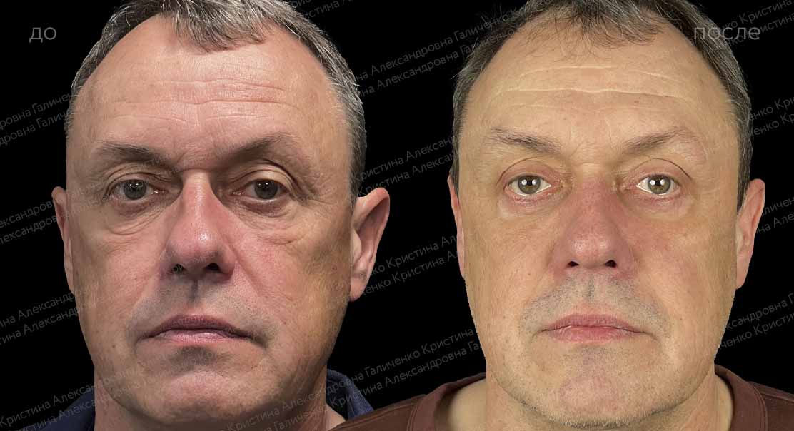 Пластика верхних и нижних век