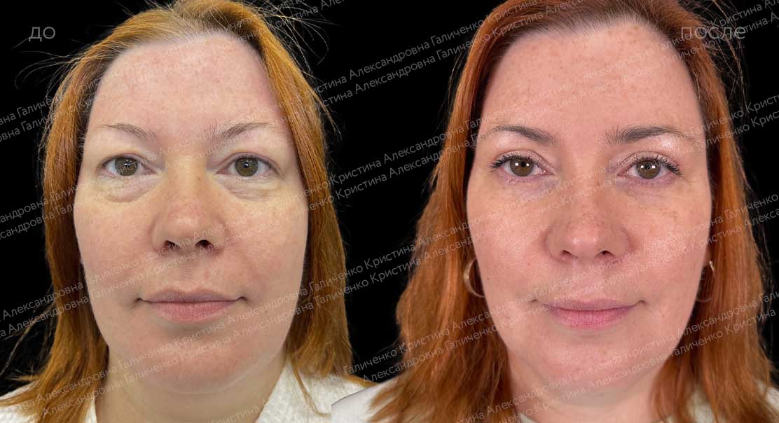 Круговая классическая блефаропластика