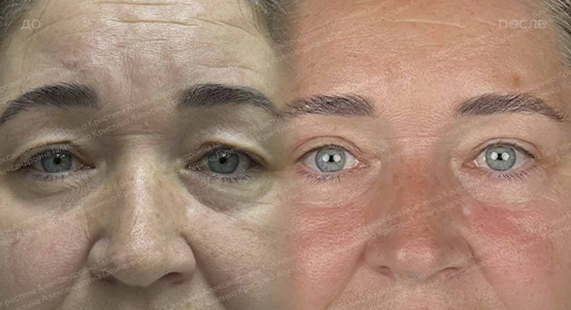 Пластика верхних и нижних век + миопексия