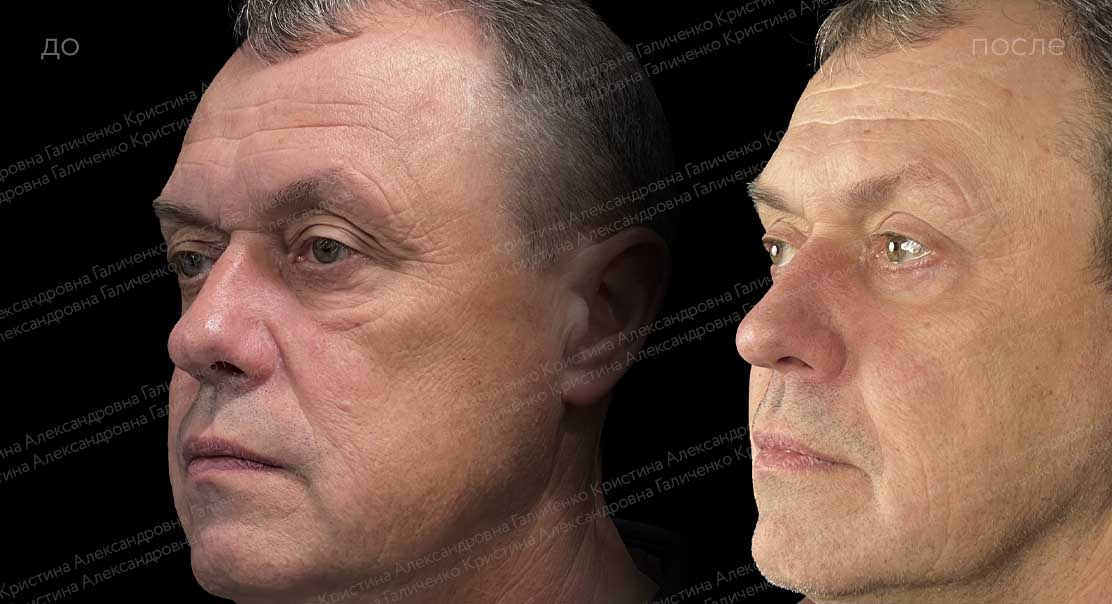 Пластика верхних и нижних век