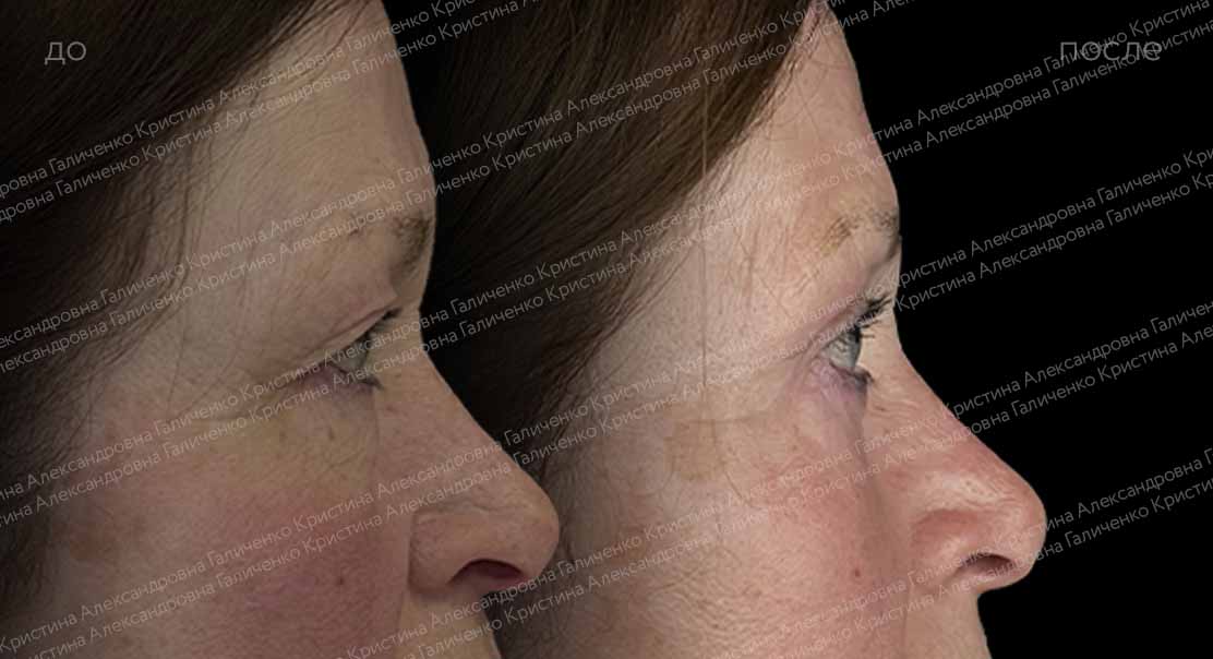 Круговая блефаропластика с миопексией