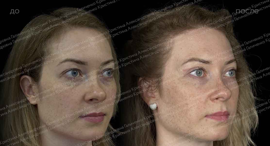 Классическая верхняя блефаропластика + трансконъюнктивальная пластика нижних век
