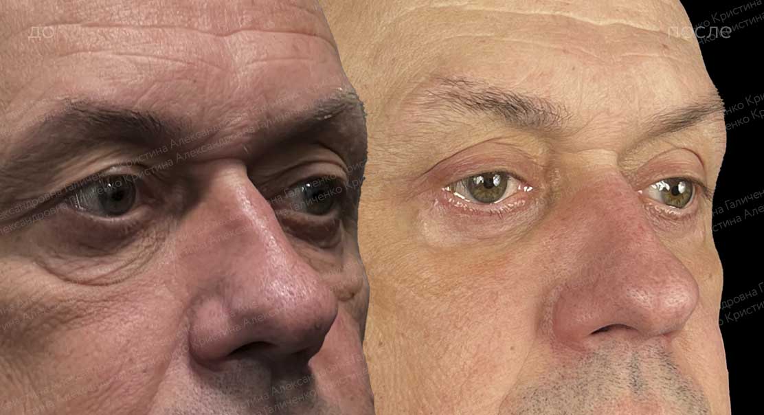 Пластика верхних и нижних век