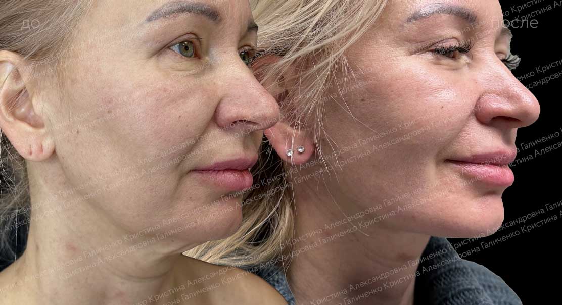 Комплексная подтяжка лица + липосакция подбородка