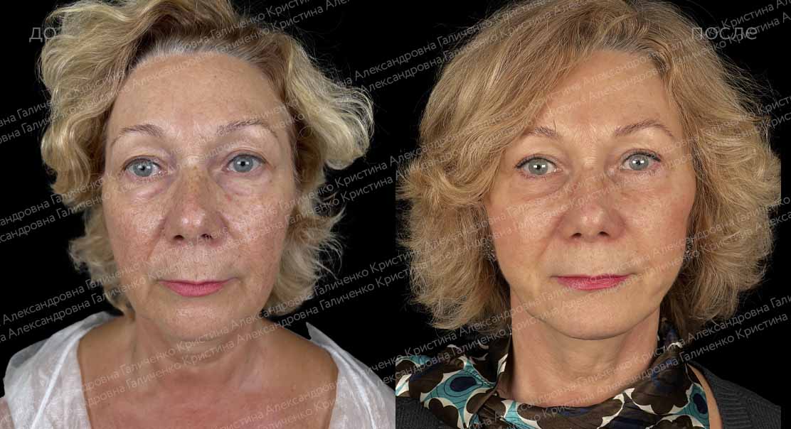 пациентка до и после пластики лба, висков и век
