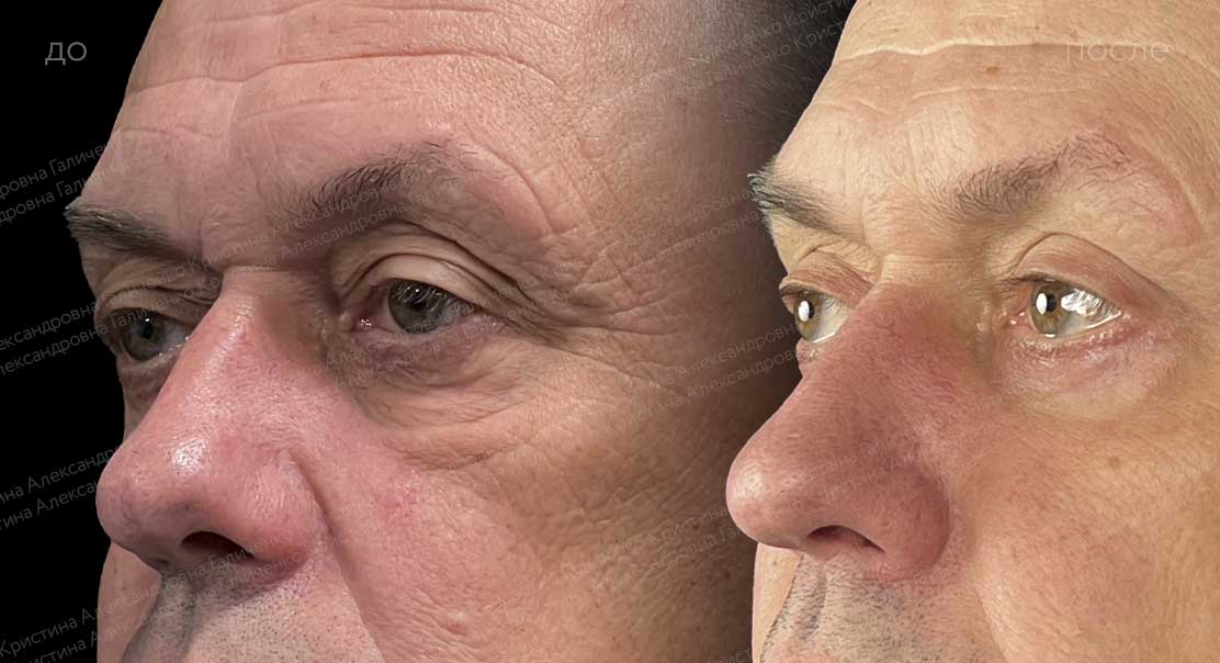 Пластика верхних и нижних век