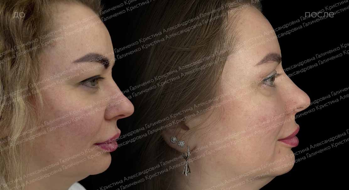 Ориентальная блефаропластика
