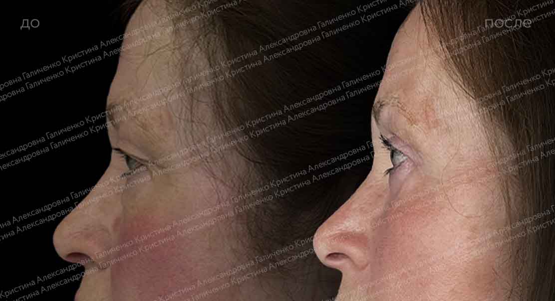 Круговая блефаропластика с миопексией