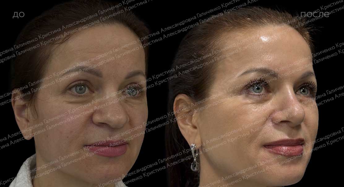 Нижняя блефаропластика с миопексией