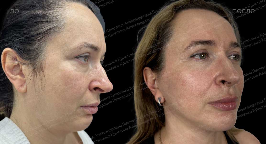 Лифтинг средней и нижней трети лица и шеи с коррекцией рубца на подбородке