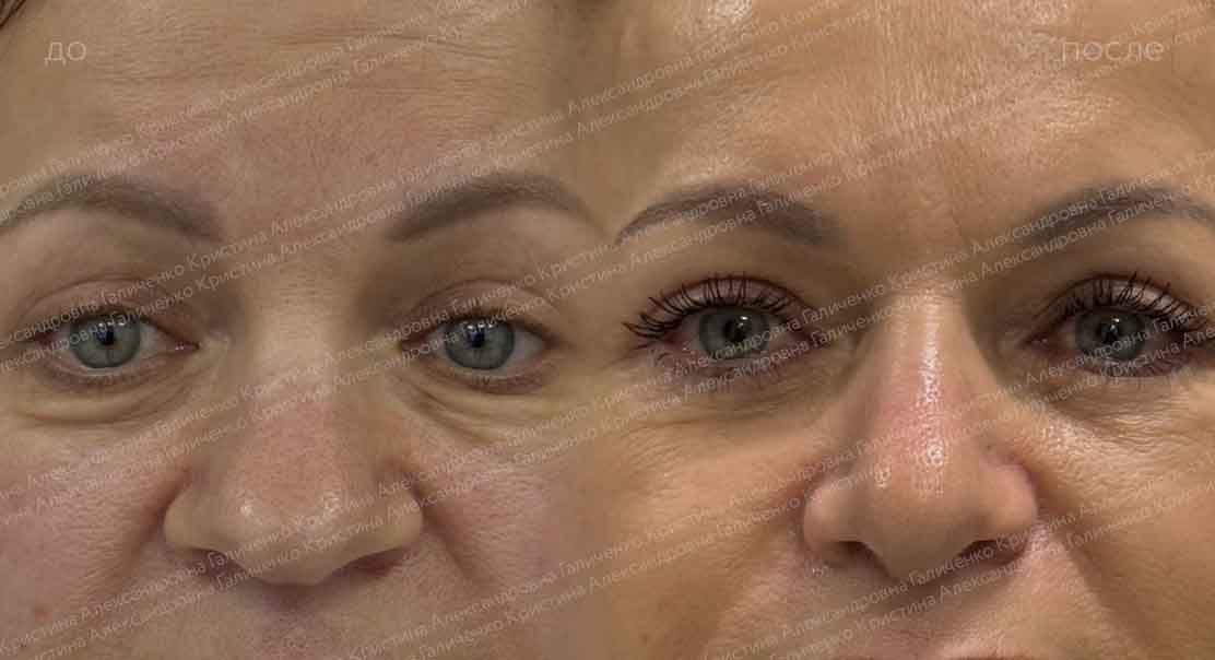 Нижняя блефаропластика с миопексией