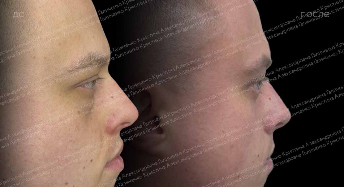 Нижняя трансконъюнктивальная блефаропластика