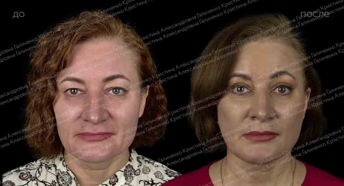 Верхняя блефаропластика
