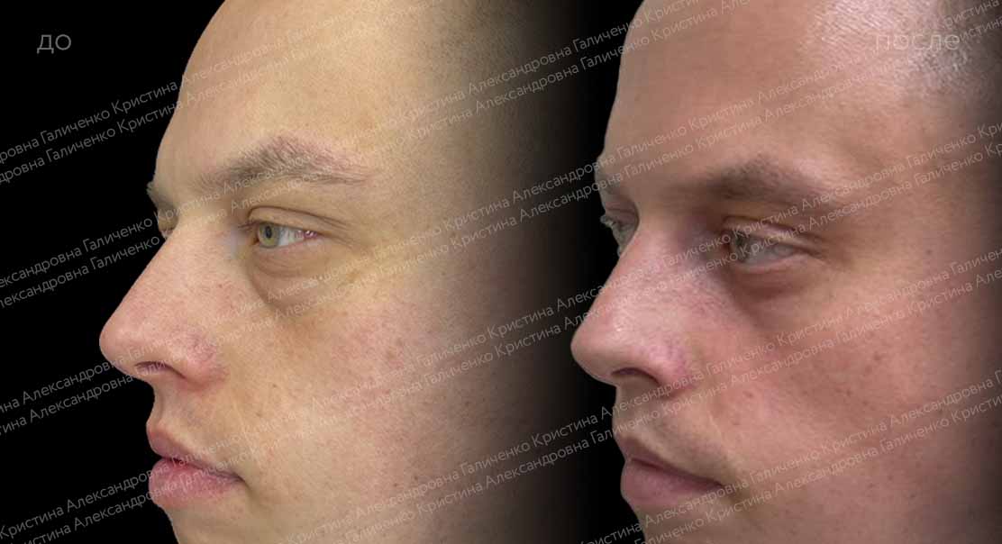 Нижняя трансконъюнктивальная блефаропластика