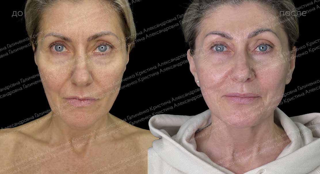 Платизмопластика + эндоскопический лобно-височный лифтинг