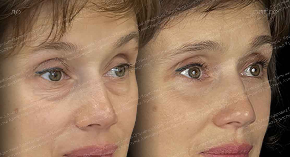 Нижняя блефаропластика и миопексия