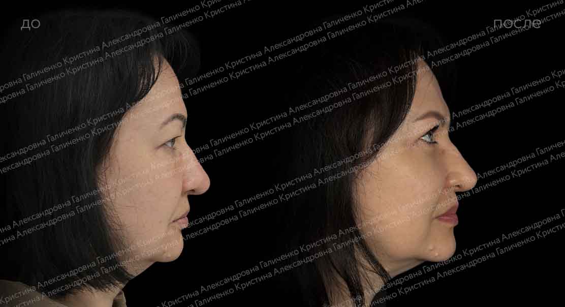 Круговая блефаропластика и миопексия