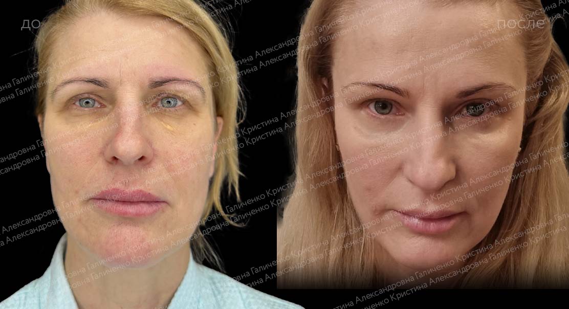 Нижняя блефаропластика + эндоскопический лобно-височный лифтинг