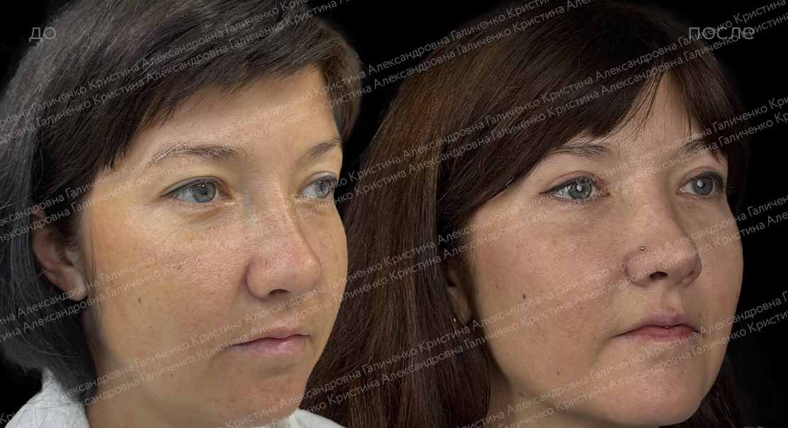 Верхняя блефаропластика