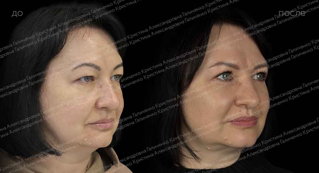 Круговая блефаропластика и миопексия