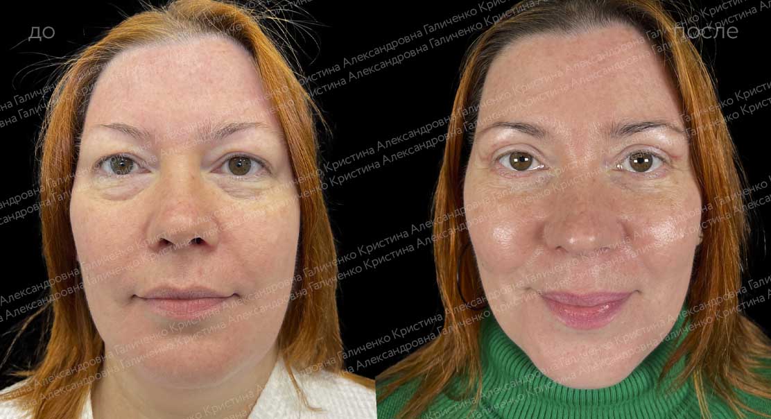 Круговая классическая блефаропластика